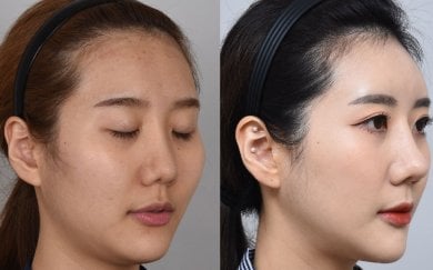 Before and after face contouring results, improved facial symmetry and jawline definition