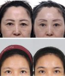 Before and after face contouring results, smoother forehead and youthful skin improvement