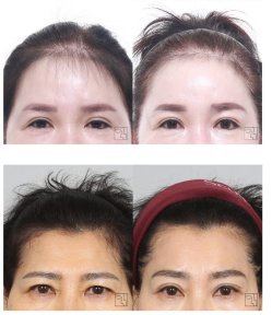 Before and after face contouring results, improved forehead and brow shape, natural look