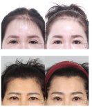 Before and after face contouring results, improved forehead and brow shape, natural look