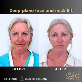 Результати до і після глибокої підтяжки обличчя та шиї в ID Clinic Bangkok, помітне омолодження