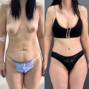 Before and after liposuction results at Dmytrii Homola Clinic, visible body contour improvement