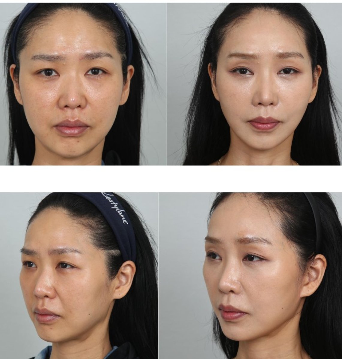 Resultados de lifting facial antes y después, rejuvenecimiento y piel más suave