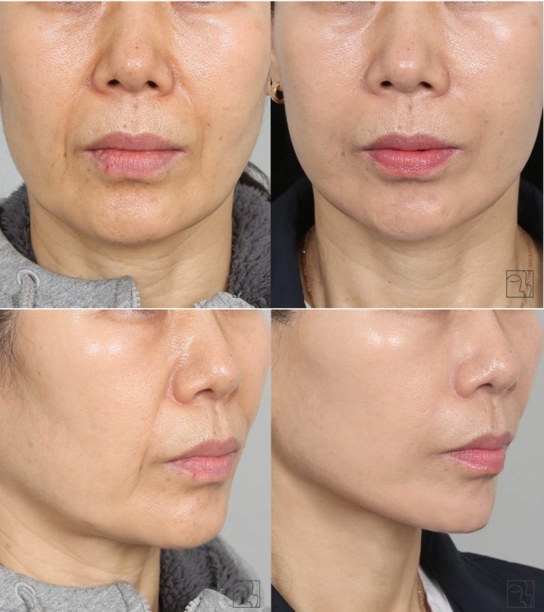 Resultados de lifting facial antes y después – rejuvenecimiento y piel más lisa