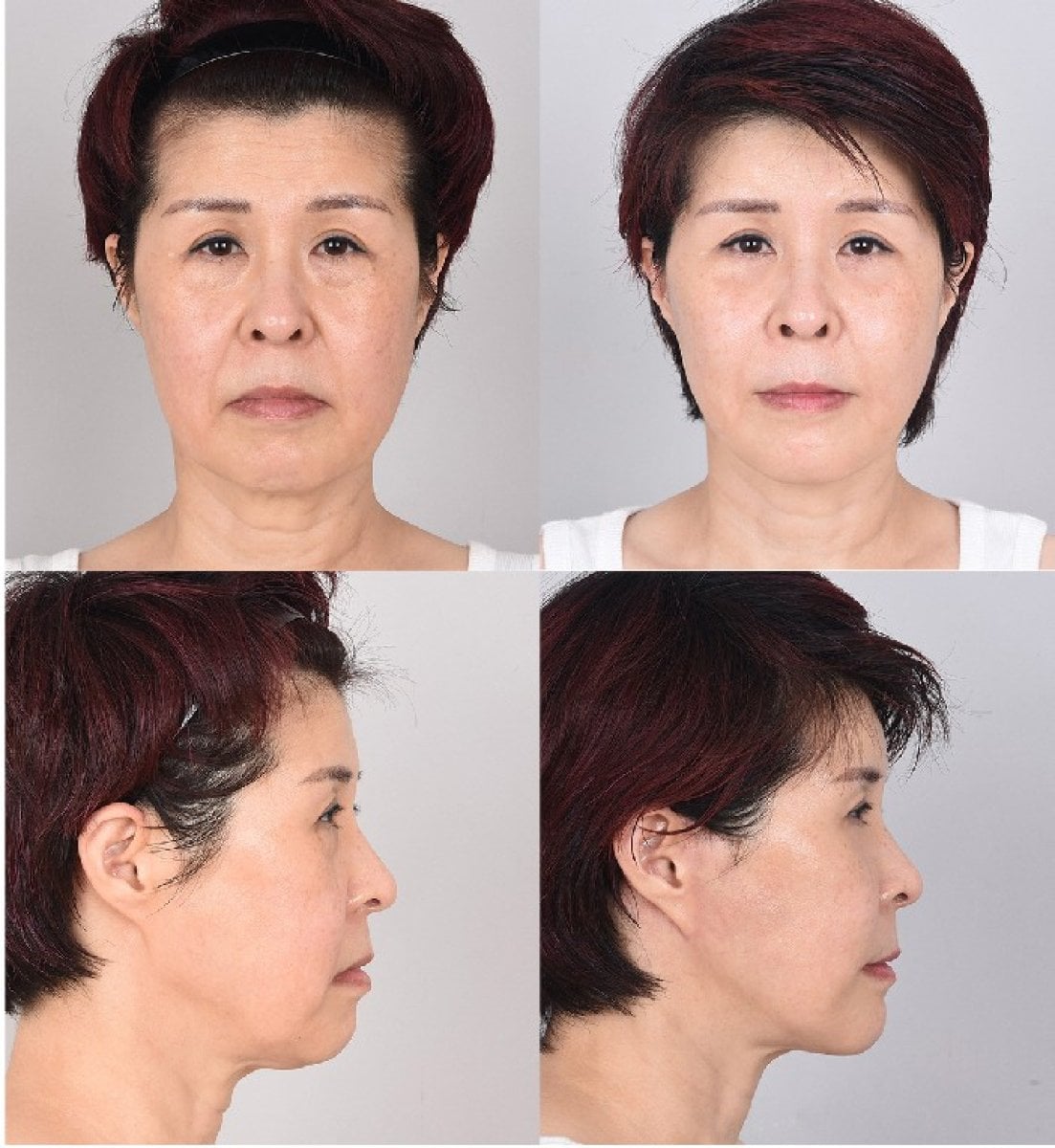 Resultados de lifting facial antes y después – rejuvenecimiento y mandíbula más firme