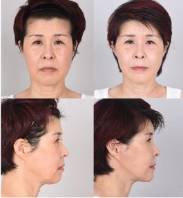 Facelift Vorher-Nachher-Ergebnis – sichtbare Verjüngung und straffere Kinnlinie