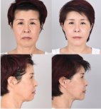 Facelift Vorher-Nachher-Ergebnis – sichtbare Verjüngung und straffere Kinnlinie