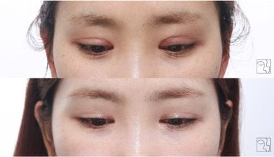 Результати до і після блефаропластики, корекція верхніх повік з природним виглядом