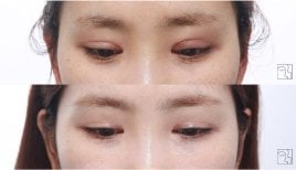 Результати до і після блефаропластики, корекція верхніх повік з природним виглядом