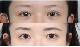 Результати блефаропластики до і після – природне покращення повік