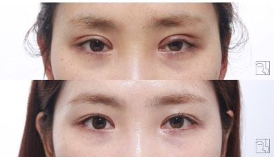 Результати блефаропластики до і після, корекція повік з природним покращенням