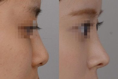 نتائج عملية تجميل الأنف قبل وبعد، إعادة تشكيل الأنف وتحسين المظهر الجانبي