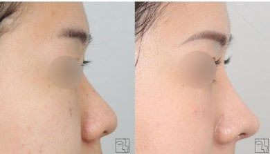 نتائج تجميل الأنف قبل وبعد، تحسين شكل الأنف والملف الجانبي بعد الجراحة