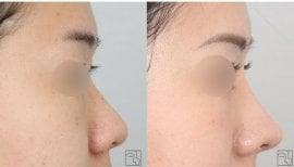 نتائج تجميل الأنف قبل وبعد، تحسين شكل الأنف والملف الجانبي بعد الجراحة