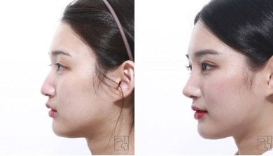 نتائج تجميل الأنف قبل وبعد، إعادة تشكيل الأنف لتحسين ملامح الوجه