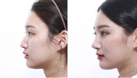 نتائج تجميل الأنف قبل وبعد، إعادة تشكيل الأنف لتحسين ملامح الوجه