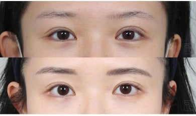 Résultats avant/après chirurgie des paupières doubles, pli palpébral visible