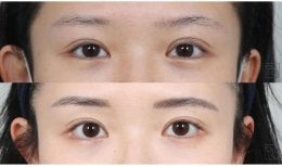Résultats avant/après chirurgie des paupières doubles, pli palpébral visible
