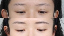 Résultats avant/après chirurgie des paupières doubles – pli palpébral accentué