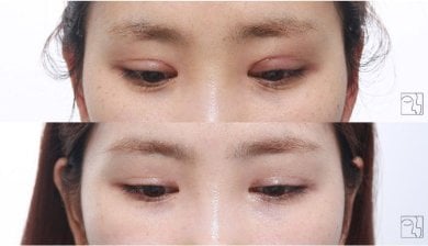Résultats avant/après chirurgie des paupières doubles, pli palpébral amélioré