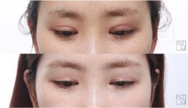 Résultats avant/après chirurgie des paupières doubles, pli palpébral amélioré