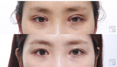 Résultats avant et après chirurgie des paupières doubles, pli palpébral visible