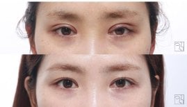 Résultats avant et après chirurgie des paupières doubles, pli palpébral visible
