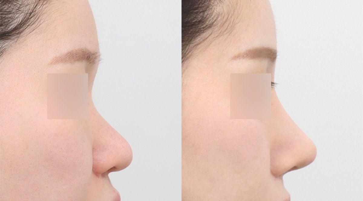 Resultados de rinoplastia antes y después en AB PLASTIC SURGERY, remodelación nasal natural