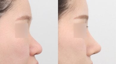 Vorher-nachher-Ergebnis der Nasenkorrektur bei AB PLASTIC SURGERY, natürliche Nasenform