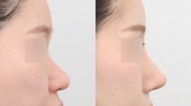 Vorher-nachher-Ergebnis der Nasenkorrektur bei AB PLASTIC SURGERY, natürliche Nasenform