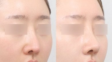 Vorher-nachher-Rhinoplastik-Ergebnisse bei AB PLASTIC SURGERY, natürliche Nasenkorrektur