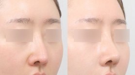 Vorher-nachher-Rhinoplastik-Ergebnisse bei AB PLASTIC SURGERY, natürliche Nasenkorrektur