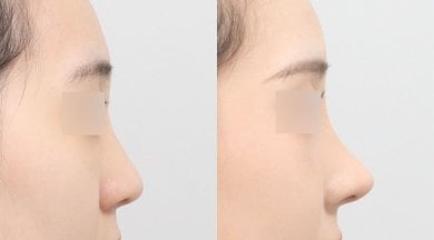 Vorher-nachher-Ergebnisse der Nasenkorrektur bei AB PLASTIC SURGERY, verbesserte Nasenkontur