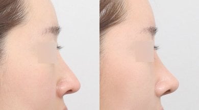 Vorher-nachher-Ergebnis der Nasenkorrektur bei AB PLASTIC SURGERY, natürliche Nasenform