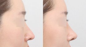 Vorher-nachher-Ergebnis der Nasenkorrektur bei AB PLASTIC SURGERY, natürliche Nasenform