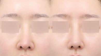 Vorher-nachher-Rhinoplastik-Ergebnisse bei AB PLASTIC SURGERY, natürliche Nasenkorrektur