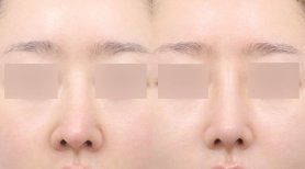 Vorher-nachher-Rhinoplastik-Ergebnisse bei AB PLASTIC SURGERY, natürliche Nasenkorrektur