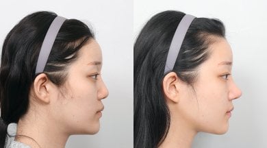 Before and after face contouring results at AB PLASTIC SURGERY, improved facial profile
