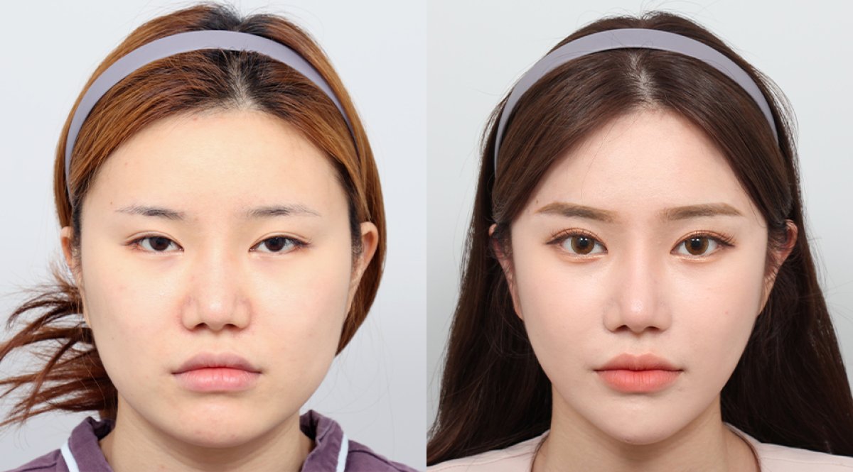 Resultados de contorno facial antes y después en AB PLASTIC SURGERY, simetría mejorada