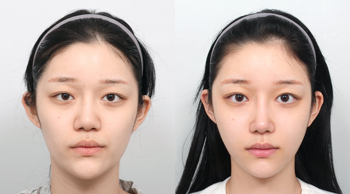نتائج تحديد الوجه قبل وبعد في AB PLASTIC SURGERY، تحسين تناسق الوجه