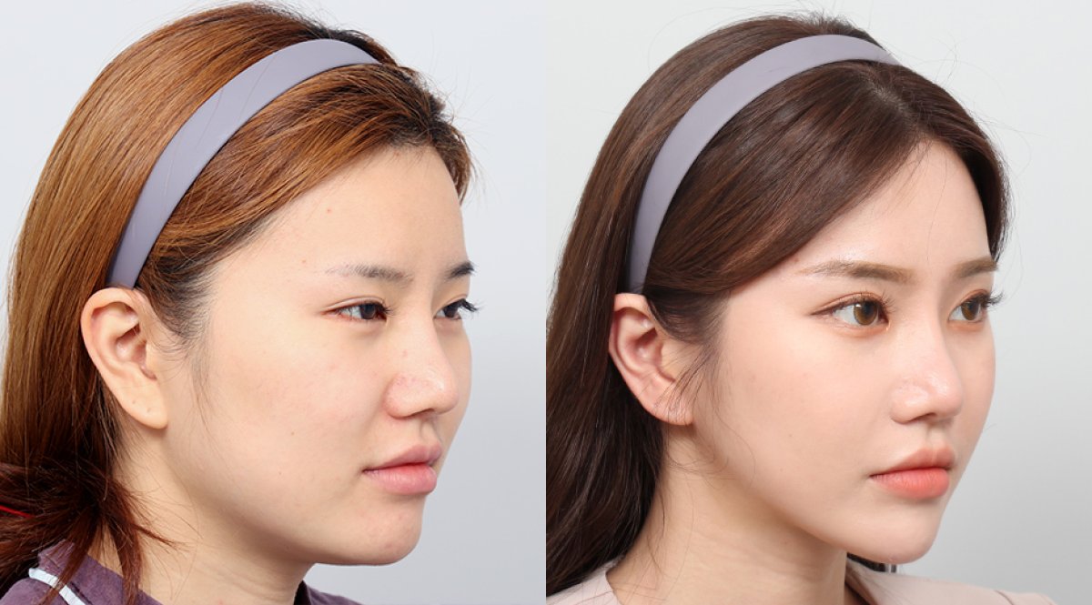 Resultados de contorno facial antes y después en AB PLASTIC SURGERY – rasgos definidos