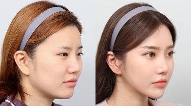 Before and after face contouring results at AB PLASTIC SURGERY – enhanced facial definition