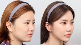 Before and after face contouring results at AB PLASTIC SURGERY – enhanced facial definition