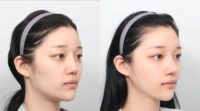 Before and after face contouring results at AB PLASTIC SURGERY, enhanced facial symmetry