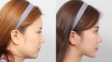 Before and after face contouring results at AB PLASTIC SURGERY, enhanced facial profile