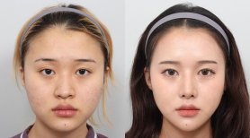 Before and after face contouring results at AB PLASTIC SURGERY, enhanced facial symmetry
