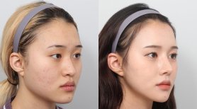 Before and after face contouring results at AB PLASTIC SURGERY, enhanced facial symmetry