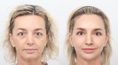 Facelift before and after results at AB PLASTIC SURGERY, facial rejuvenation and smoother skin