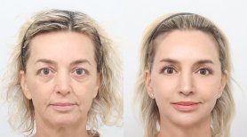 Facelift before and after results at AB PLASTIC SURGERY, facial rejuvenation and smoother skin