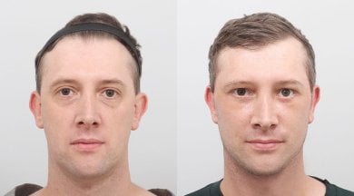 Facelift before and after results at AB PLASTIC SURGERY, visible facial rejuvenation